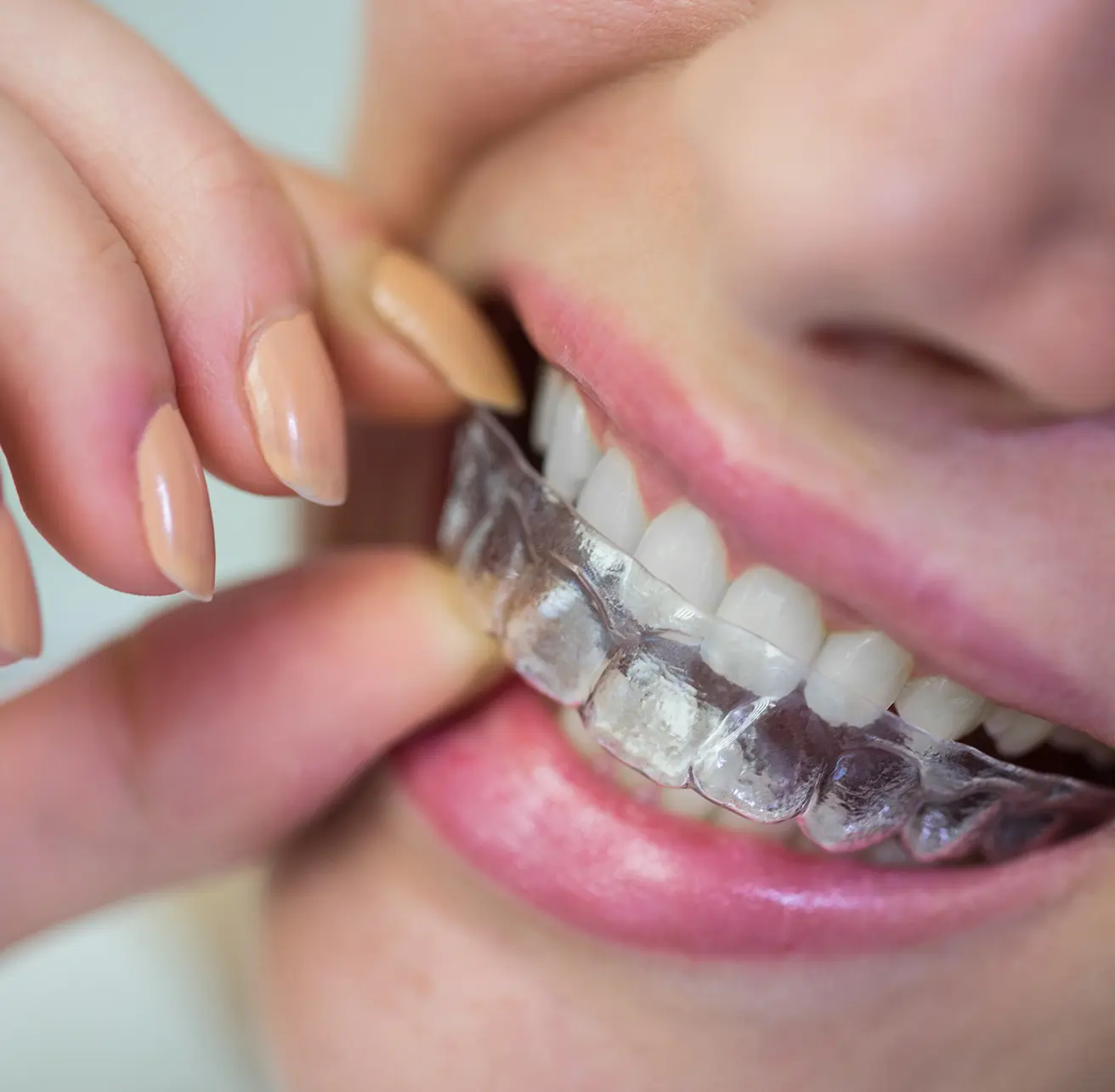 Rehabilitación Oclusal